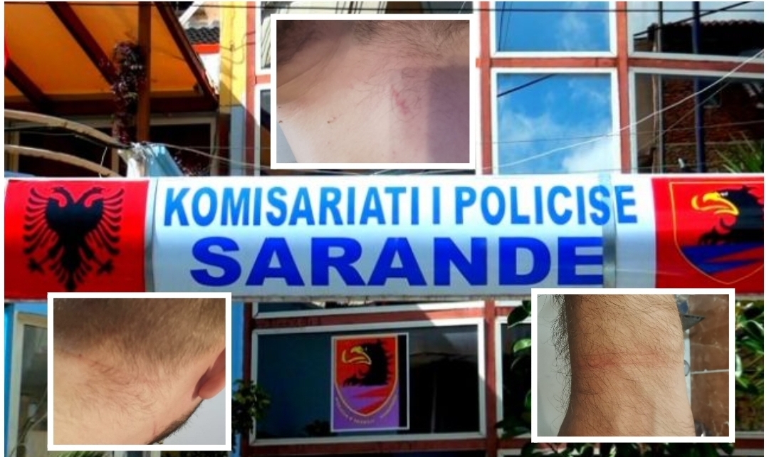 Qytetari denoncon dhunën e ushtruar në Komisariatin e Policisë Sarandë